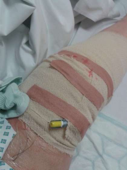 bandage after TKR